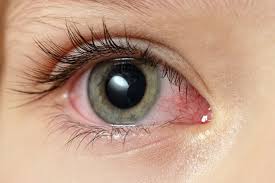 Close-up of a green eye with redness in the white of the eye